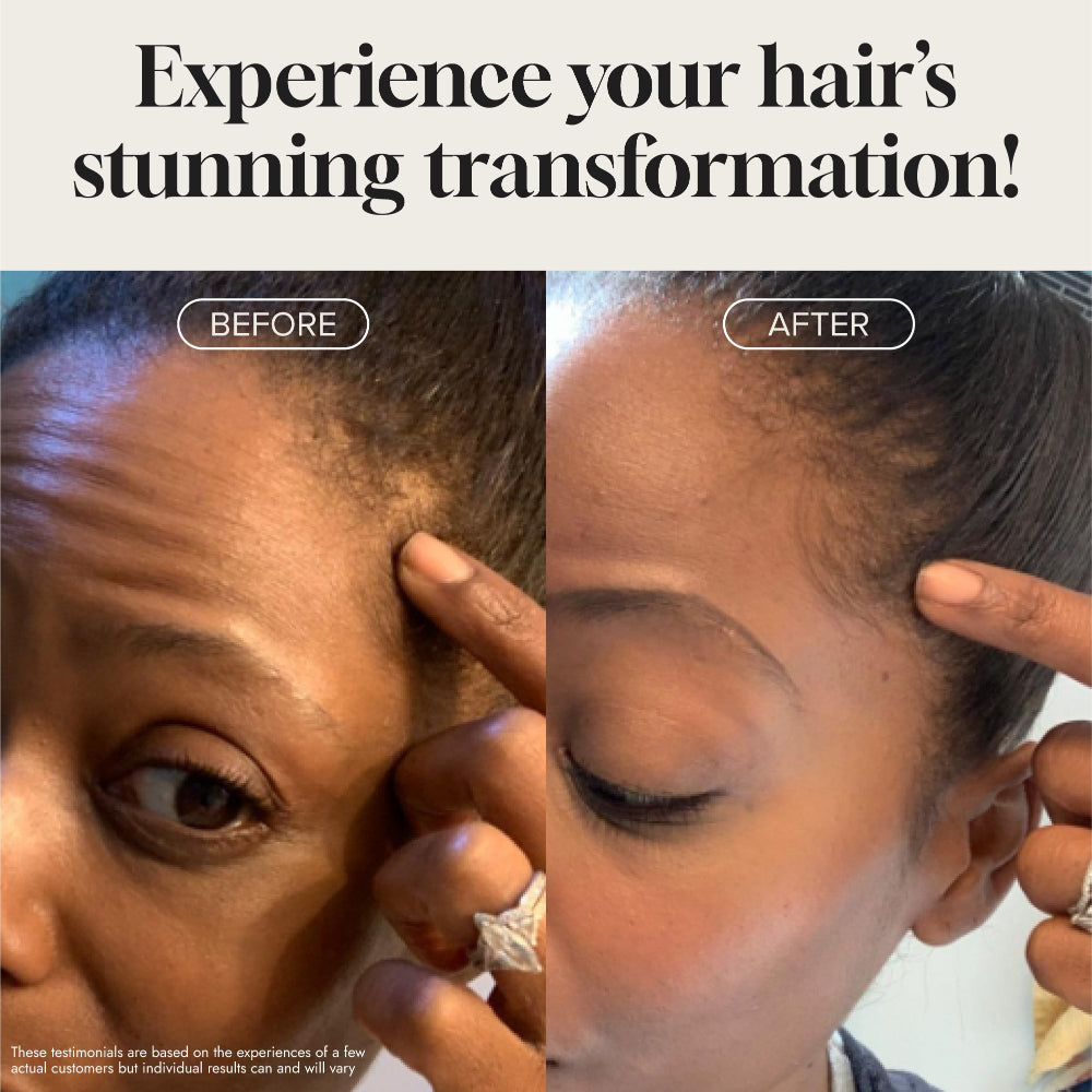 Before and after’ hair growth testimonial images next to serum bottle indicating thicker fuller hair results